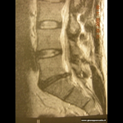 Pre-op:la discopatia L5-S1